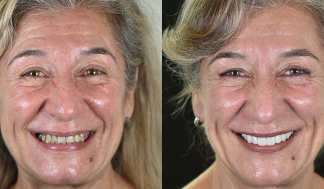 A Transformação Completa de um Sorriso com Implantes e Facetas (caso clínico)