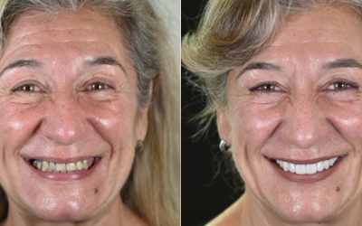 A Transformação Completa de um Sorriso com Implantes e Facetas (caso clínico)
