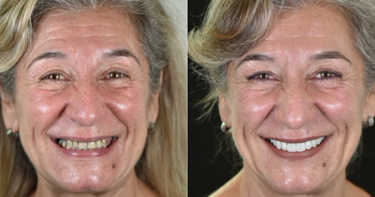 A Transformação Completa de um Sorriso com Implantes e Facetas - Caso clínico: Paciente Aurélia