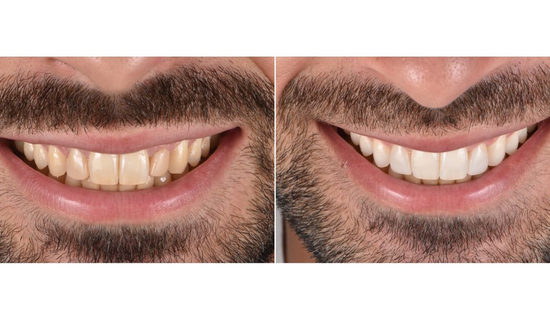 Branqueamento Dentário: O Guia Completo Para Dentes Mais Brancos