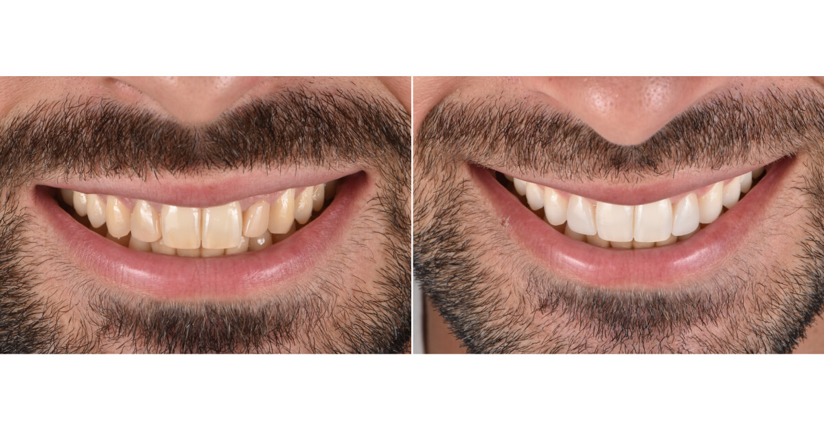 Branqueamento Dentário: O Guia Completo Para Dentes Mais Brancos