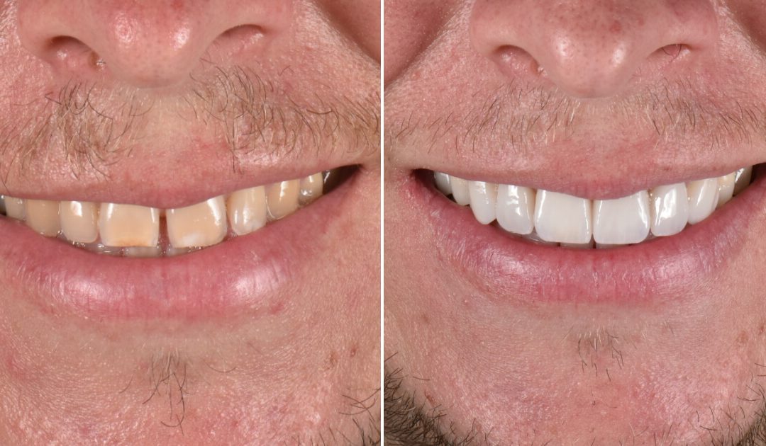 Facetas Dentárias: Antes e Depois da Transformação (caso clínico)