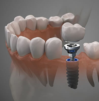 Implantes Dentários: Restaurando Sorrisos e a Função