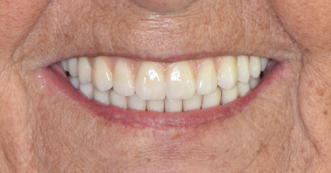 Exemplo de implante dentário de um paciente de MD Klinic.