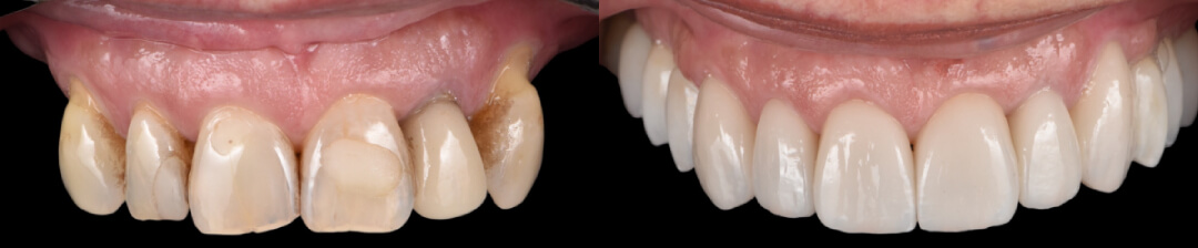 Reabilitação Completa: Dentes e Implantes em Sintonia 
