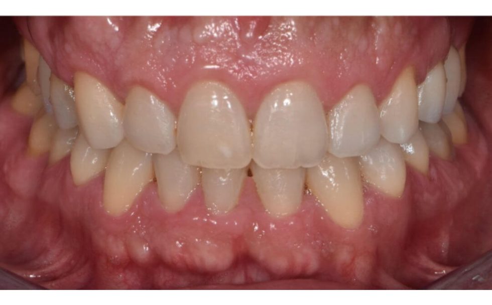 Caso Clínico 7: Ortodontia e Implantologia - o Depois do Tratamento